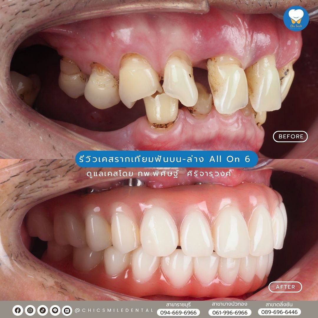 เครื่อง VPro5 คืออะไร? —— เป็นเครื่องมือพิเศษ ช่วยให้ #invisalign แนบ ...