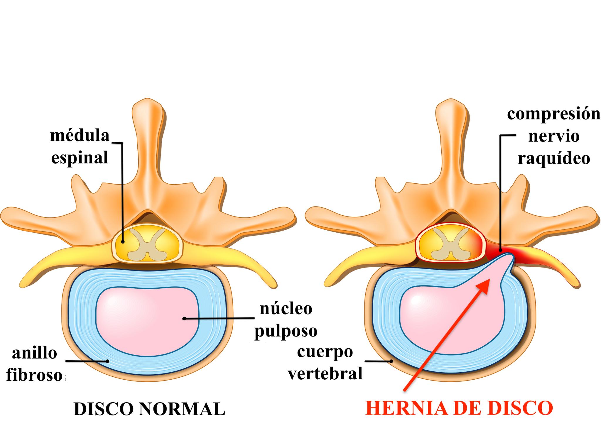 traumacor-c-mo-se-origina-una-hernia-discal-cervical-te-lo