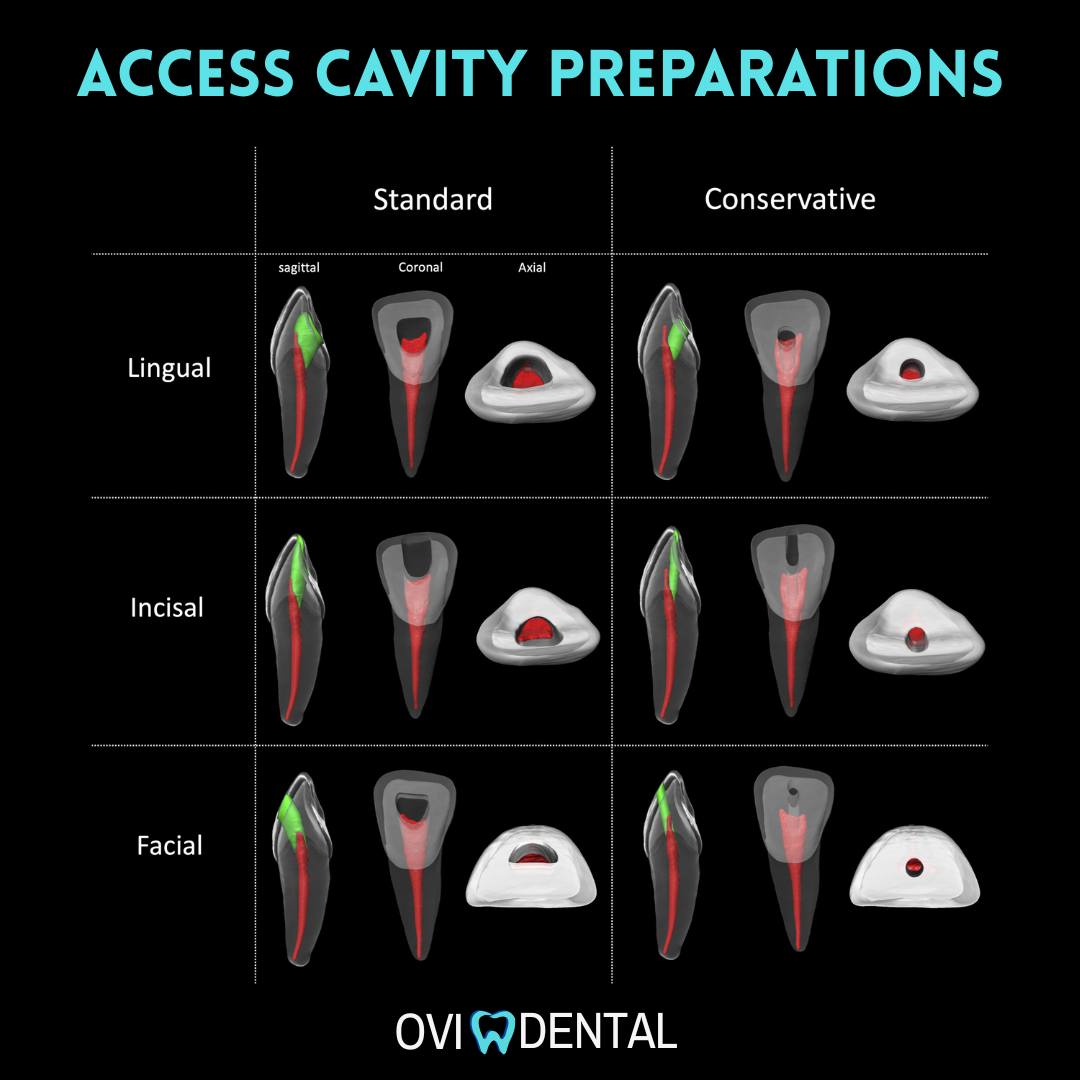 OVIdental - 🚫 Access Cavity Preparations in Endodontics: Standard vs ...