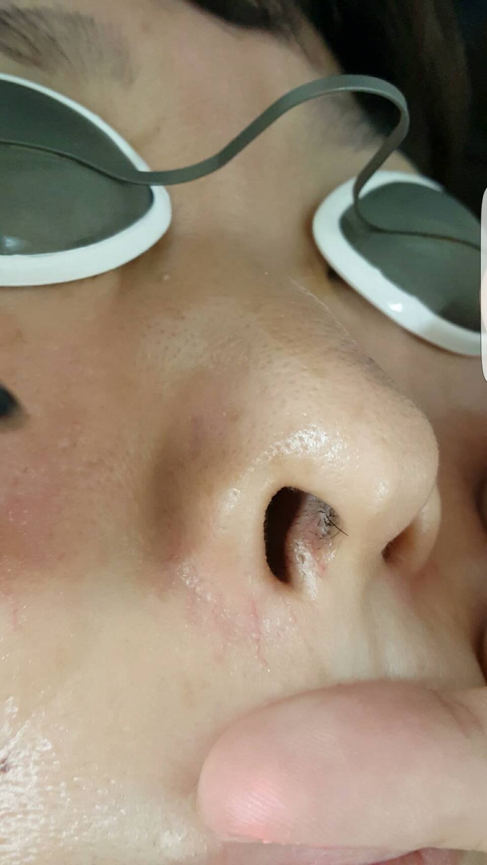 八重洲形成外科 美容皮膚科 鼻の下の赤いピロピロ 鼻の下の毛細血管拡張の治療動画が見にくいのでキャプチャ画像です Facebook
