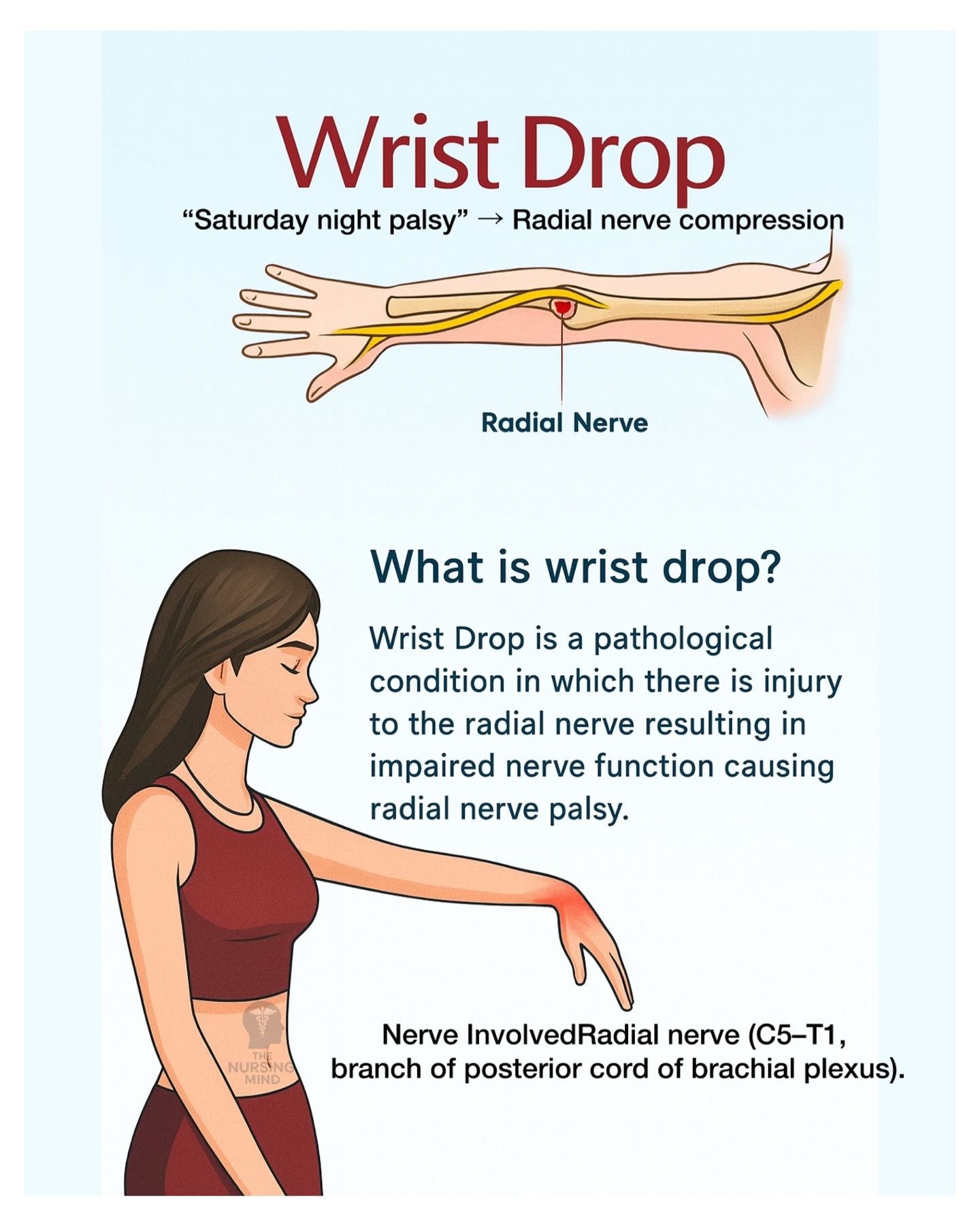 The Nursing - 💡 Wrist Drop = Radial Nerve Injury A classic sign where ...