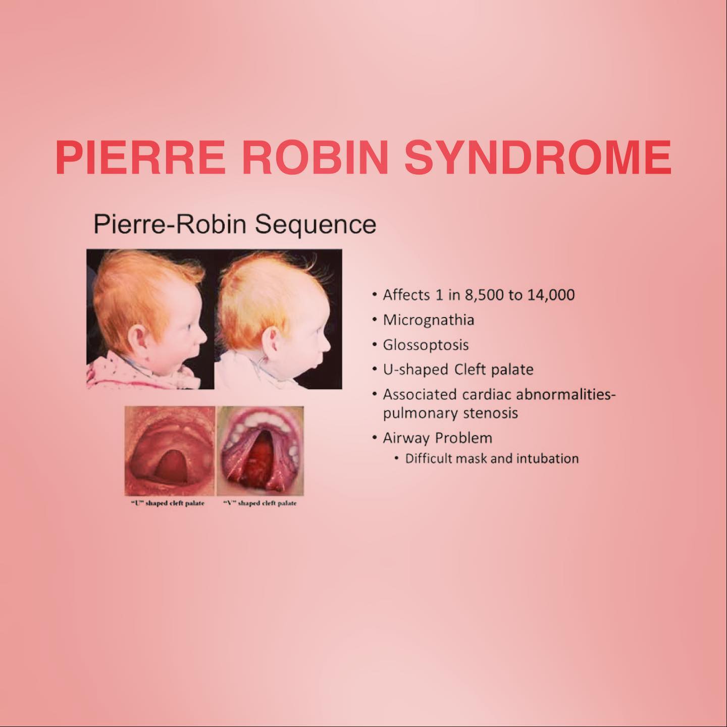 Alis N U Pierre Robin Syndrome Is A Rare Congenital Facebook