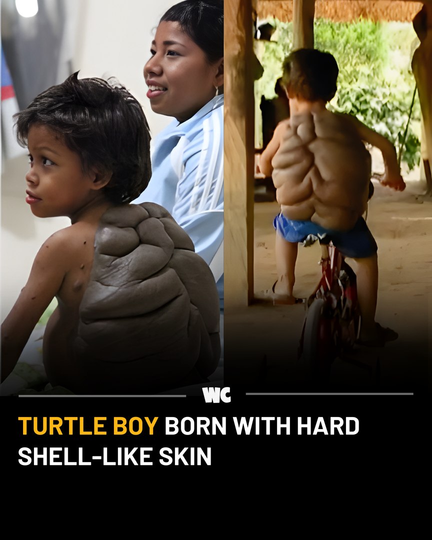 Watercooler - That boy was Didier Montalvo, born with a rare condition ...