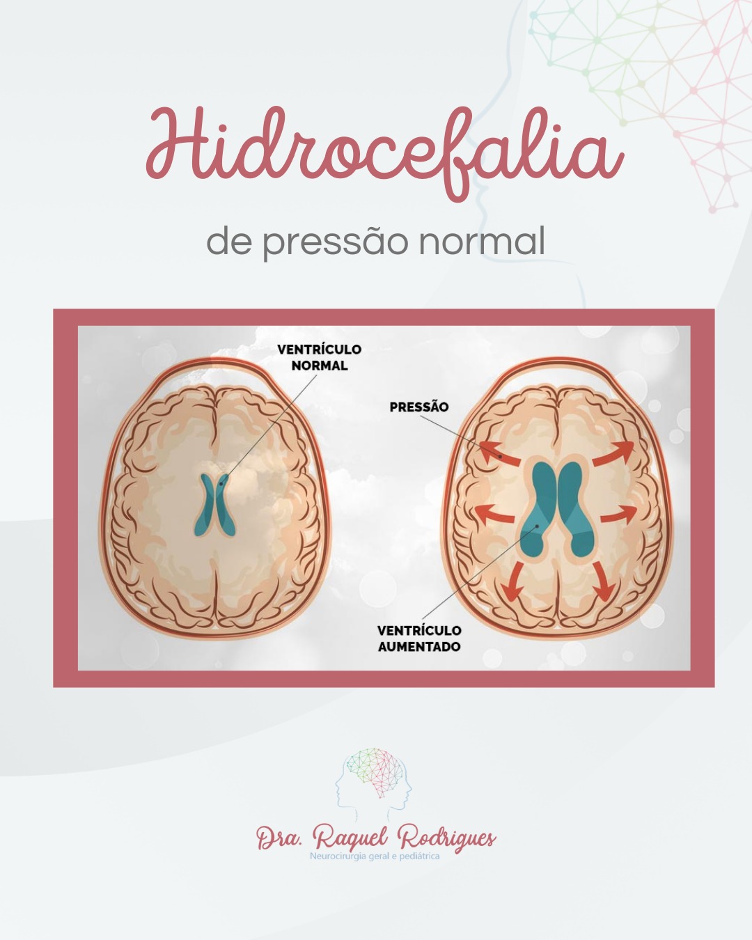 Dra - 📌 A hidrocefalia ocorre quando há um aumento anormal na ...