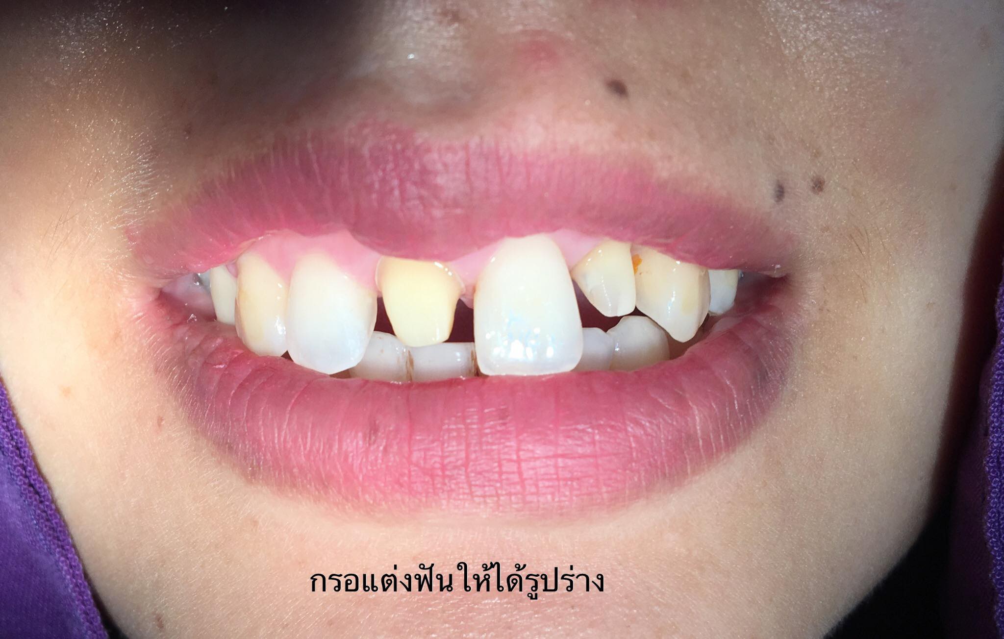 Smile Day คลินิกจัดฟัน ฟันปลอม รากเทียม ฟอกสีฟัน เคหะ-เซฟวัน added a ...