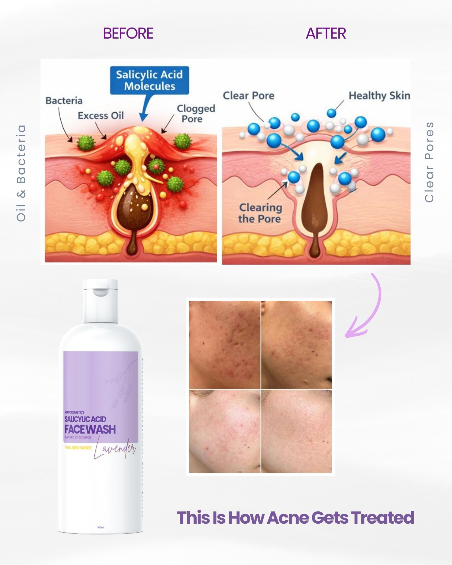 RUK - When You Use a Salicylic Acid Face Wash – THIS Is What Happens ...