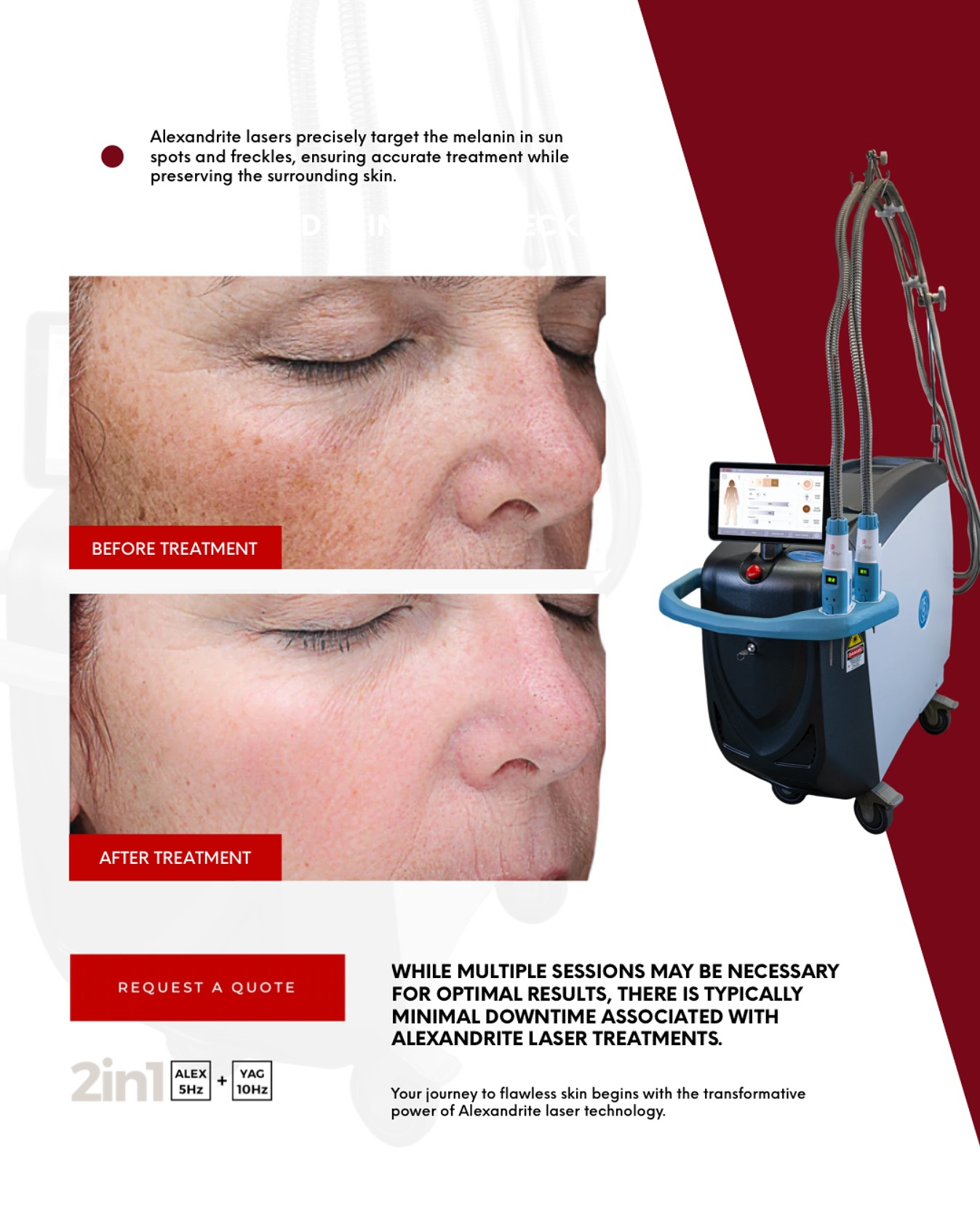 DDC - The Power of Alexandrite Laser Technology Alexandrite lasers ...
