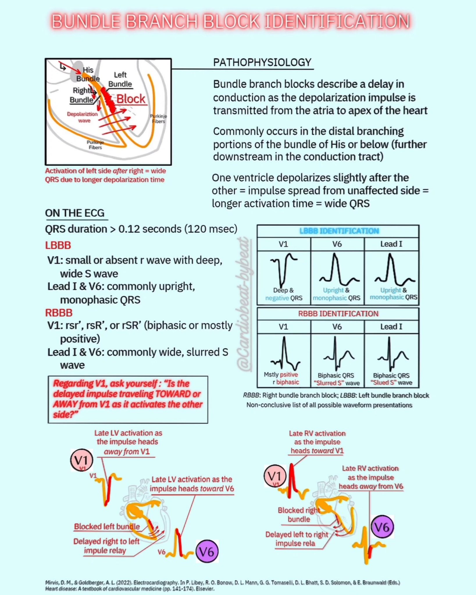 Abdallah - Left vs. Right Bundle Branch Block: Pathogenesis & Clinical ...