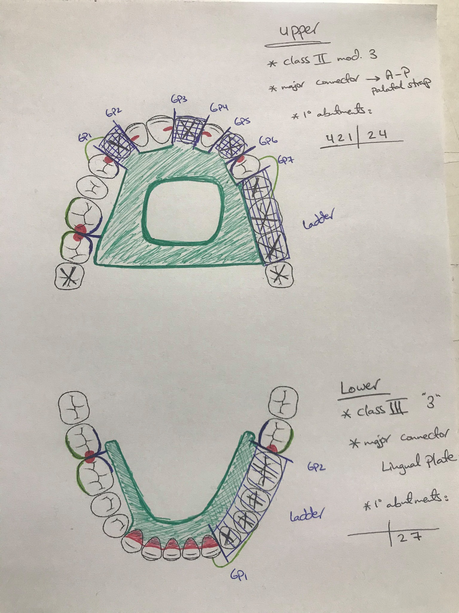 #RPD Designs - part 1... - Dental Booklets &Training Clinic | Facebook