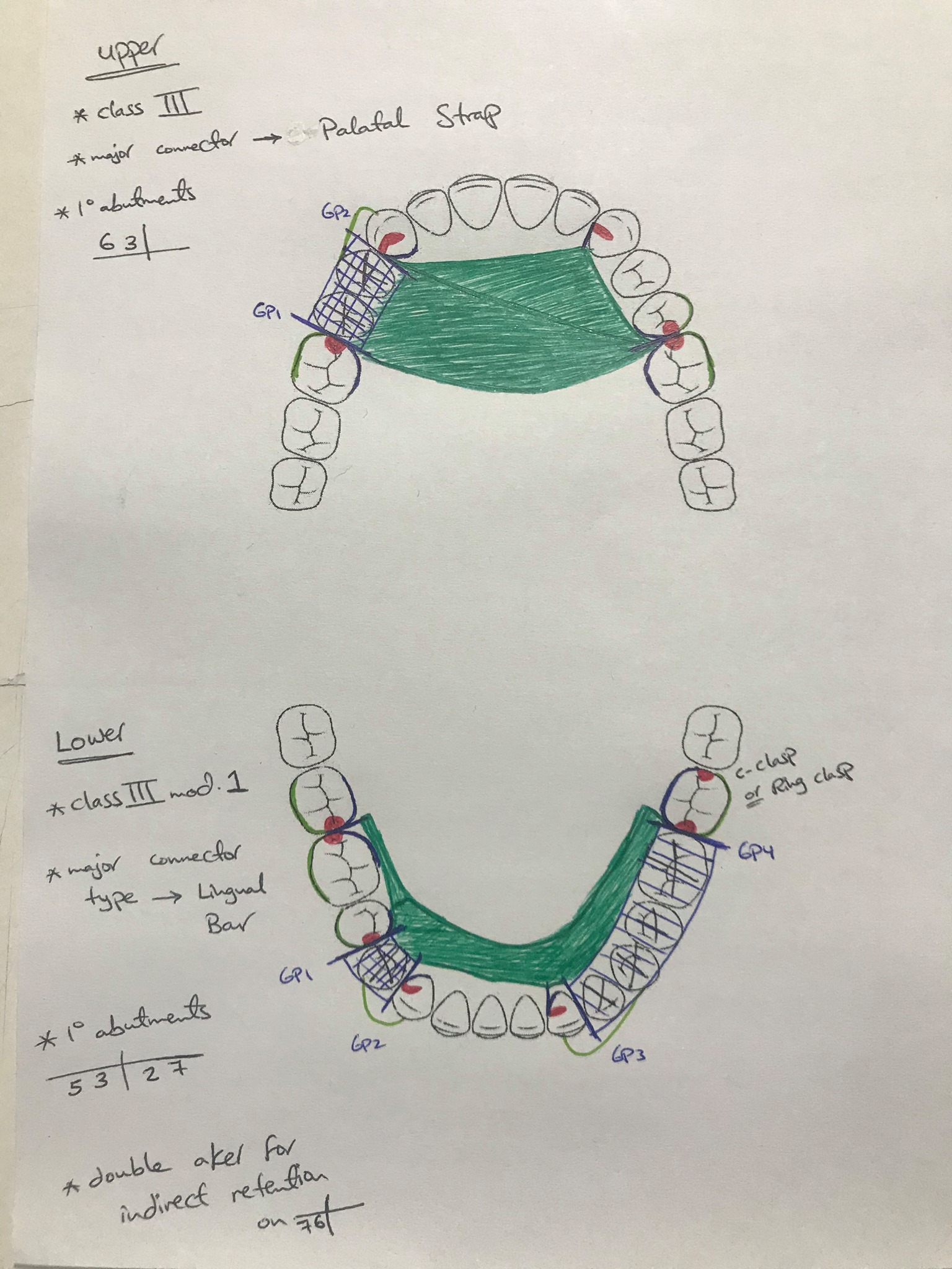 #RPD Designs - part 1... - Dental Booklets &Training Clinic | Facebook