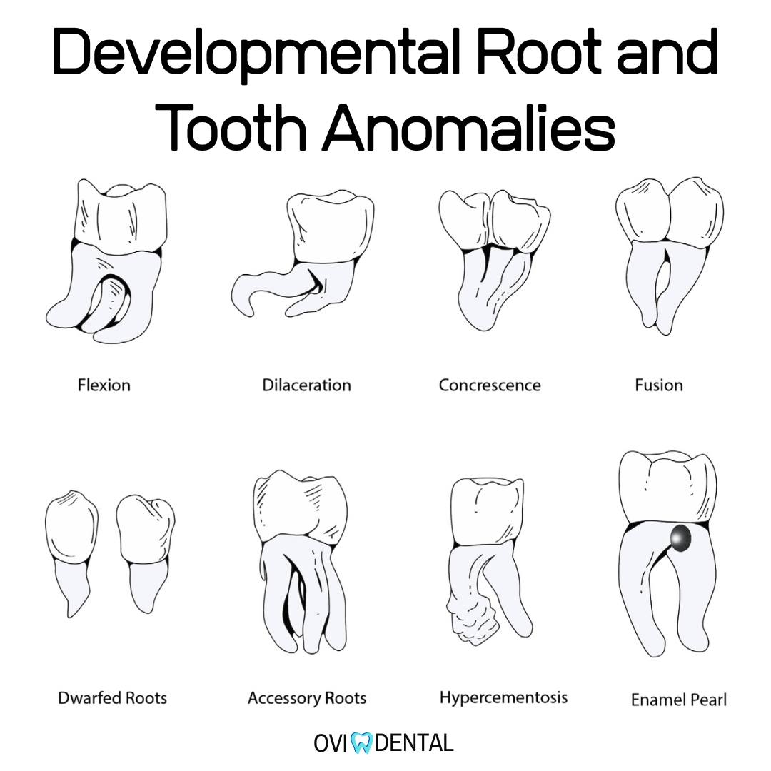 OVIdental Go - 🚫 Developmental Root and Tooth Anomalies: A... | Facebook