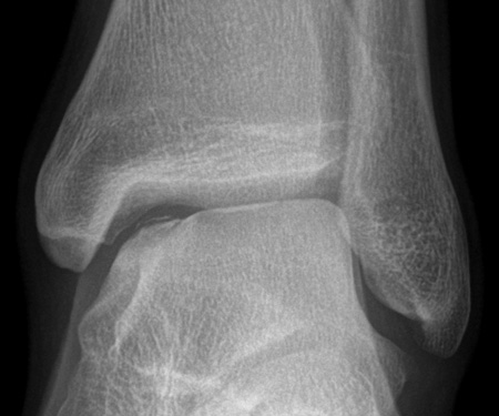 Radiology - TRAUMA X-RAY 46: Inversion injury to ankle. What is the ...