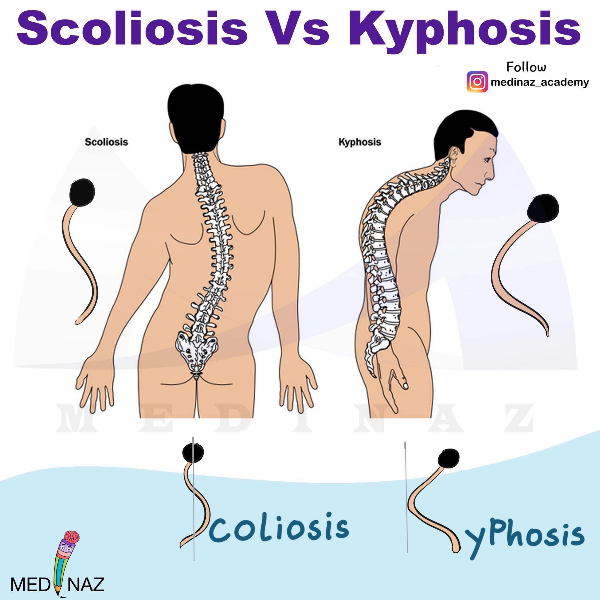 Medinaz - Scoliosis: Lateral curvature of the spine... | Facebook