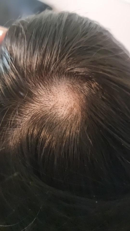 l carnitine hair loss reddit Has anyone dealt with a burning scalp and due to anxiety/stress? Snow Caps VS Ishigaki daily-skincare-routine Package:Kit (10 vials)