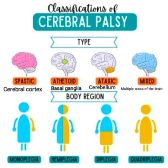 M.R - #cerebralpalsy #types #brain_affected_part There are different ...