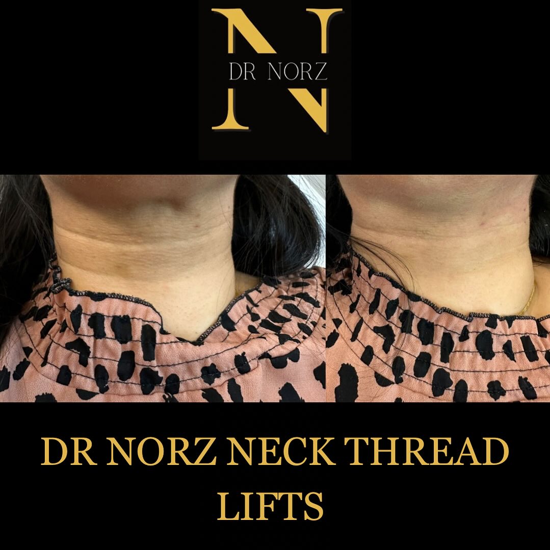 DR - DR NORZ Signature Thread-lifts Before and After. • Instant Results ...