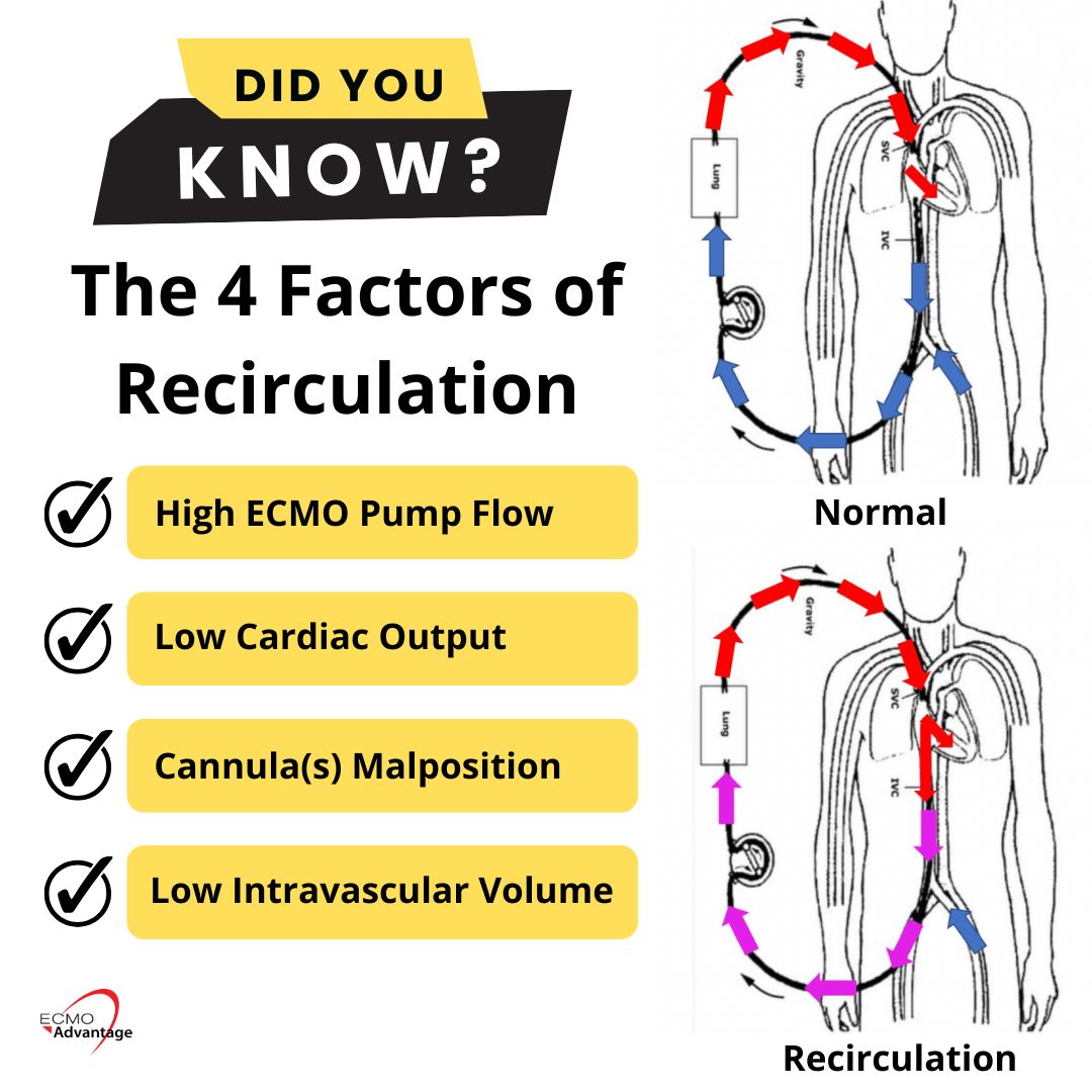 ECMO - 🔄 Having recirculation in VV ECMO can lead to serious issues ...