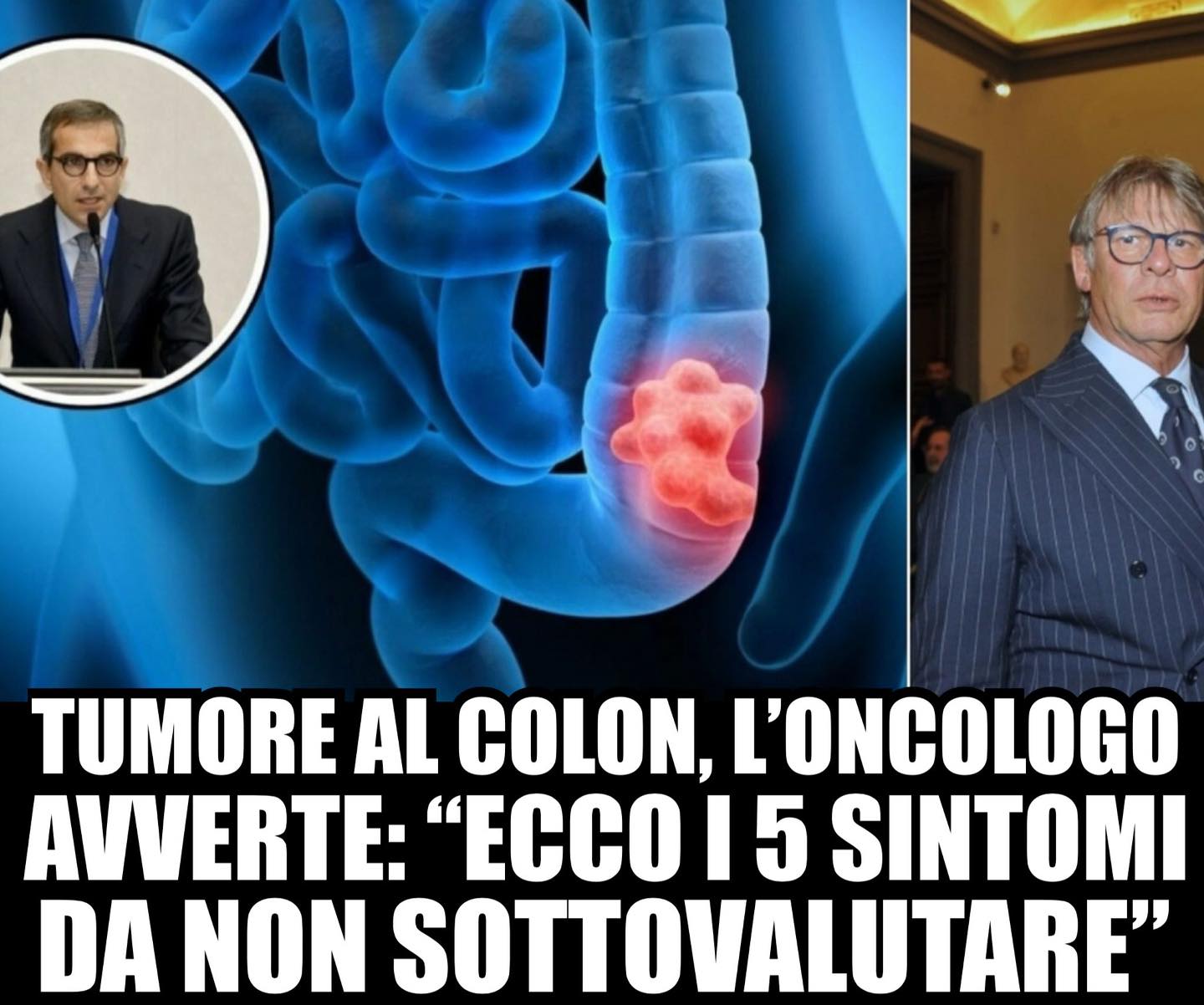 The Social - Tumore al colon, l’oncologo avverte: “Ecco i 5 sintomi da ...