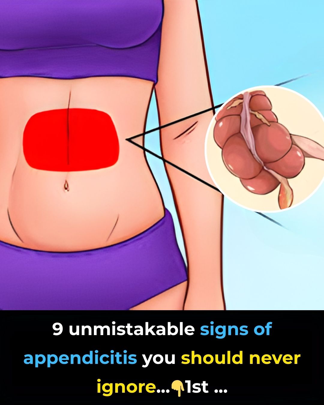 K Line - Most people miss the early warning signs of appendicitis ...