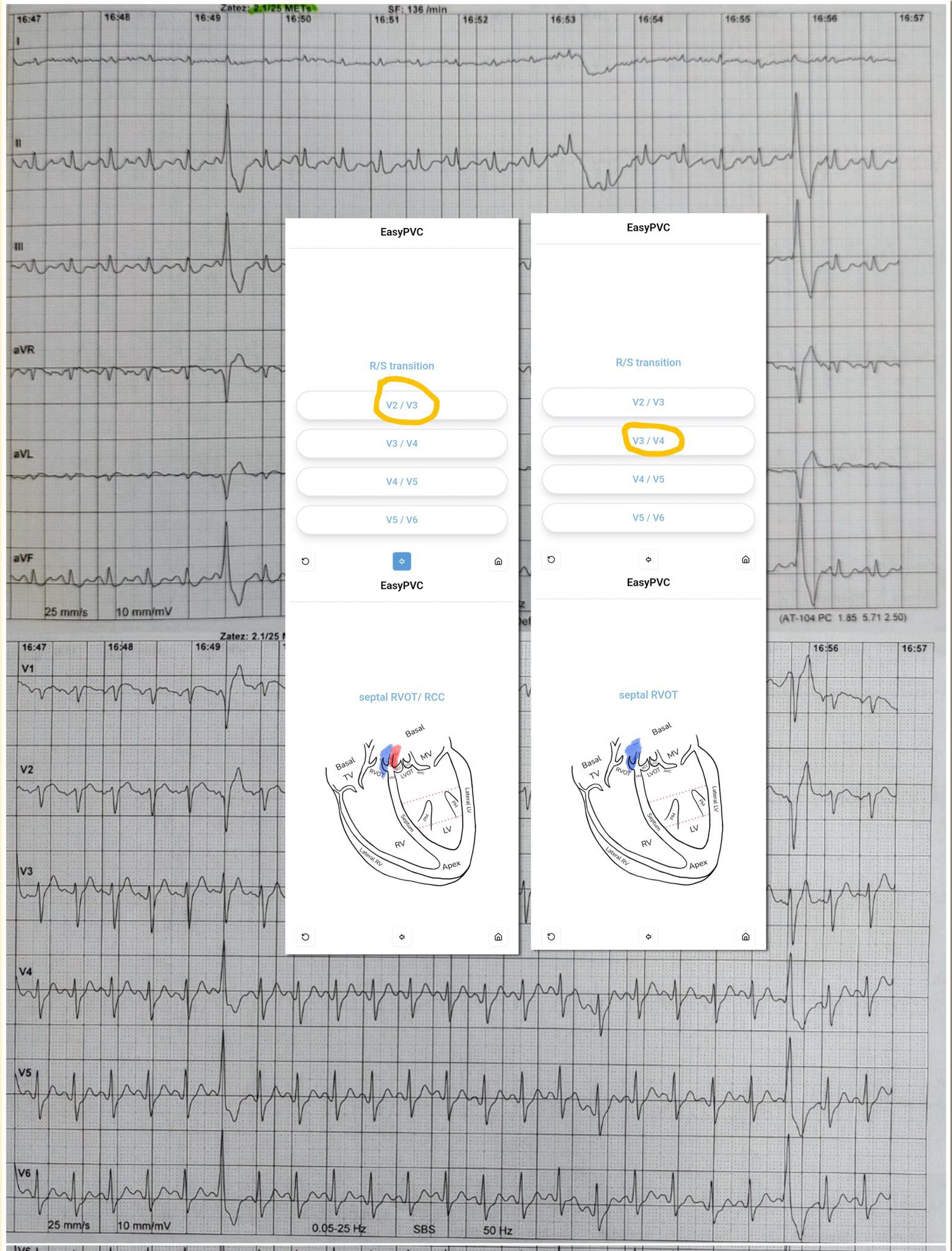 Cardiophilia - Where is the origin of PVCs Easy PVC app... | Facebook