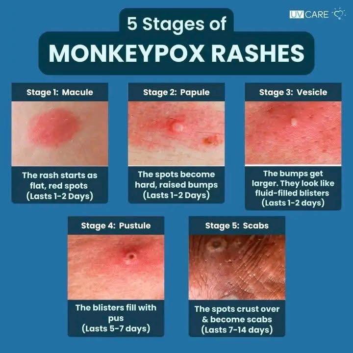 THE 5 STAGES SYMPTOMS OF MONKEYPOX... - Jaotv51_Official | Facebook