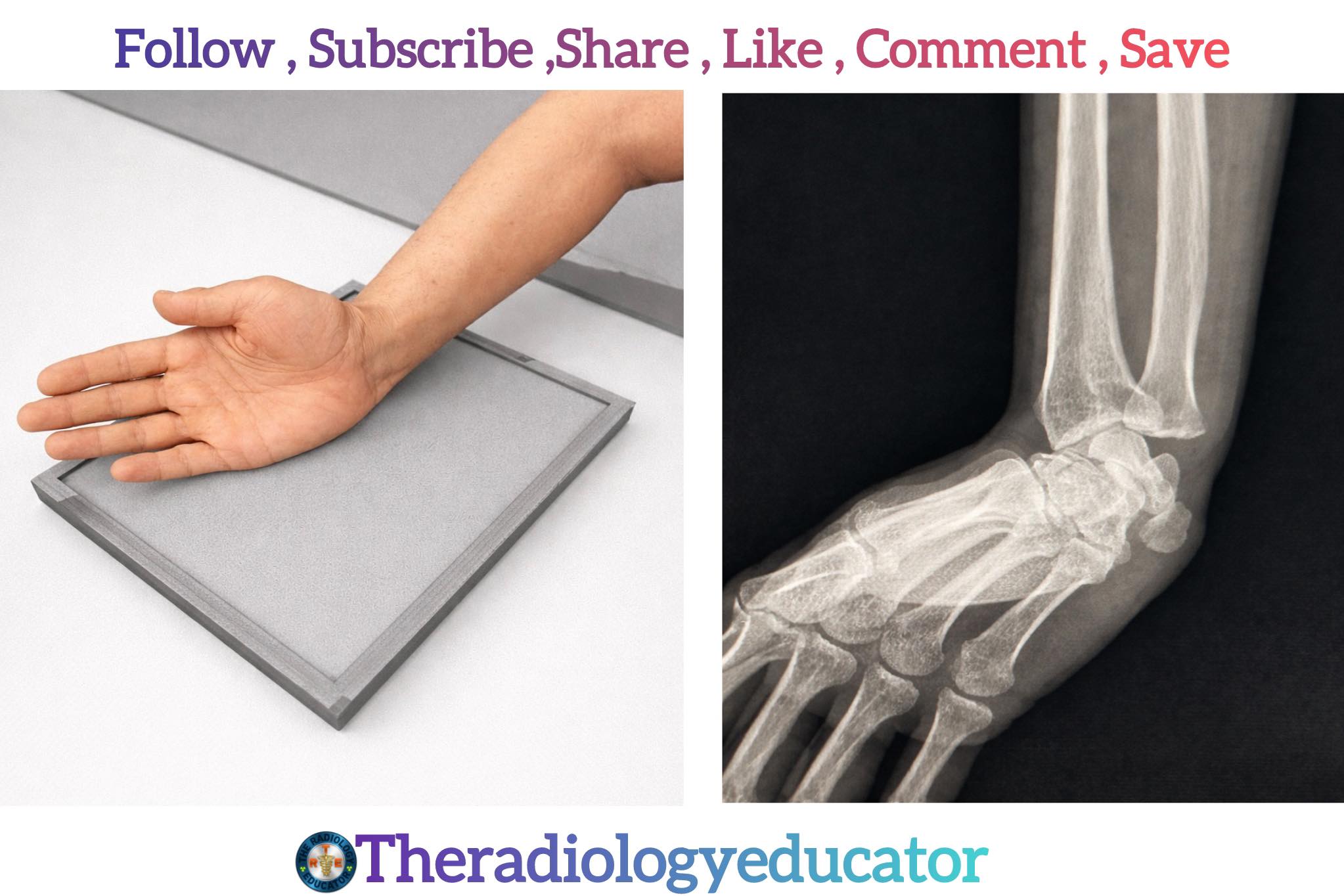 The Radiology - WRIST TANGENTIAL ( CARPAL PISIFORM) VIEW🔰: •Wrist ...