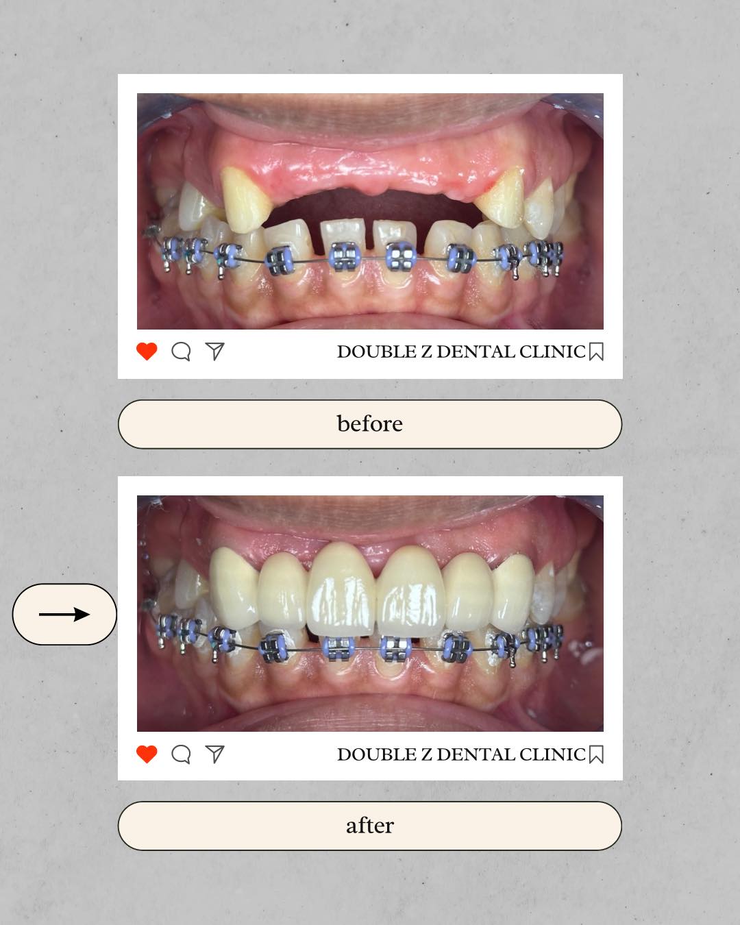 Double - Here’s our patient’s BEFORE and AFTER the installation of 6 ...