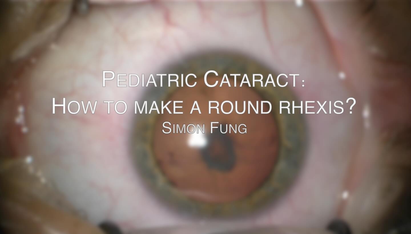 Dr. - Mastering the Rhexis in Pediatric Cataract Surgery! Creating a ...