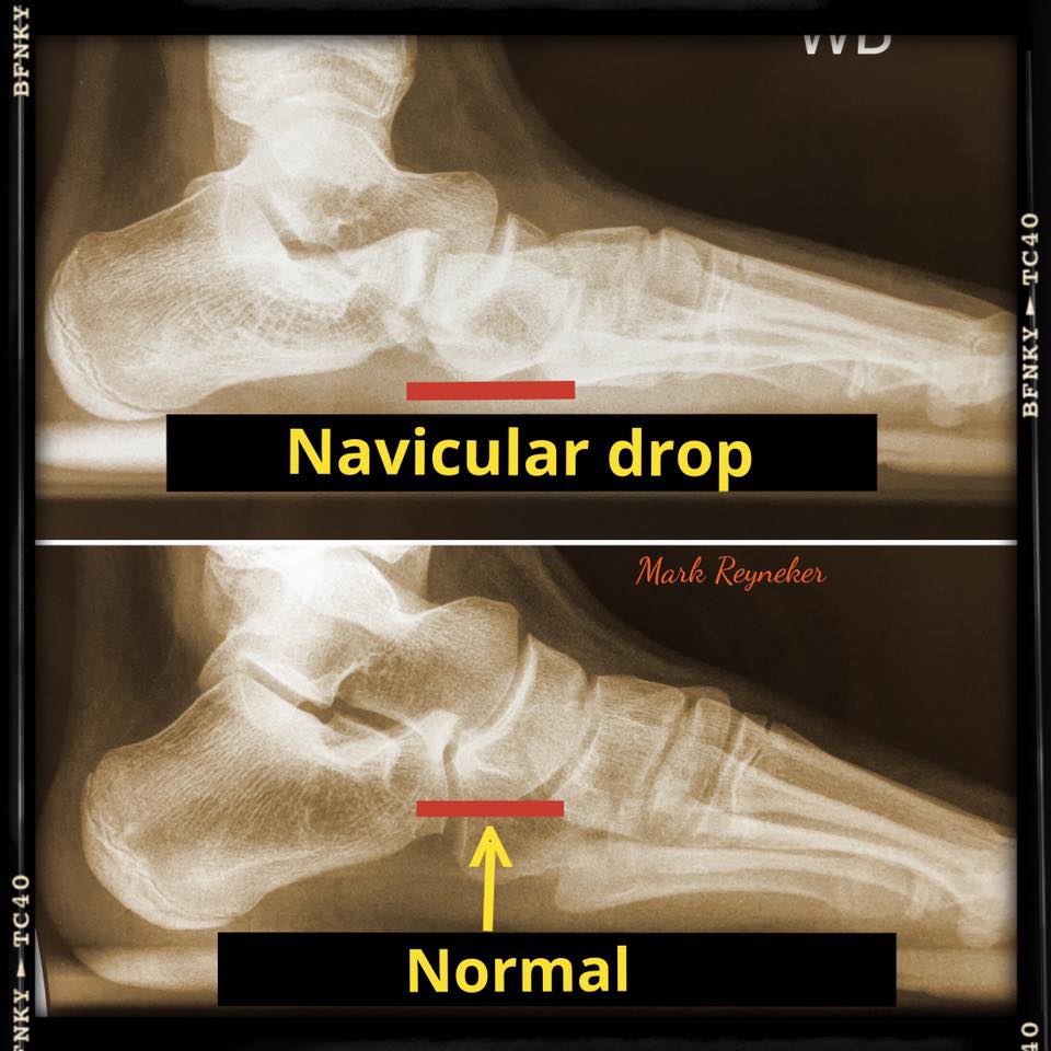 Family - The left and right foot of the same person. The first image is ...