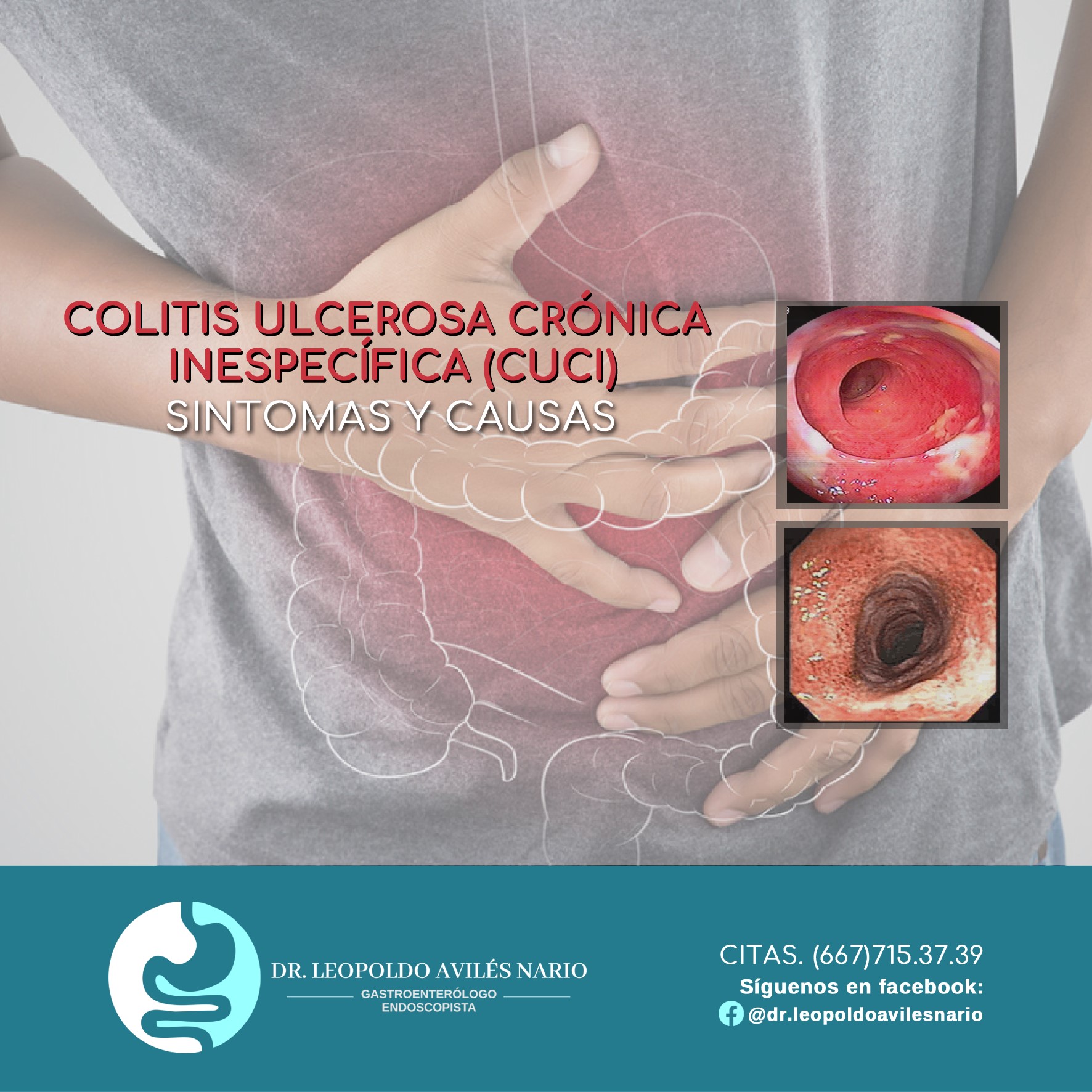 #Colitis #ulcerosa #crónica #inespecífica (CUCI) es una enfermedad ...