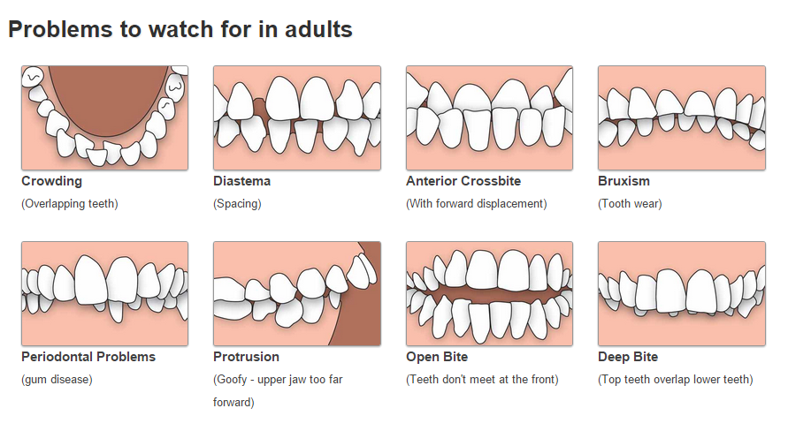 Orthodontics - Problems to watch for in adults Crowding... | Facebook