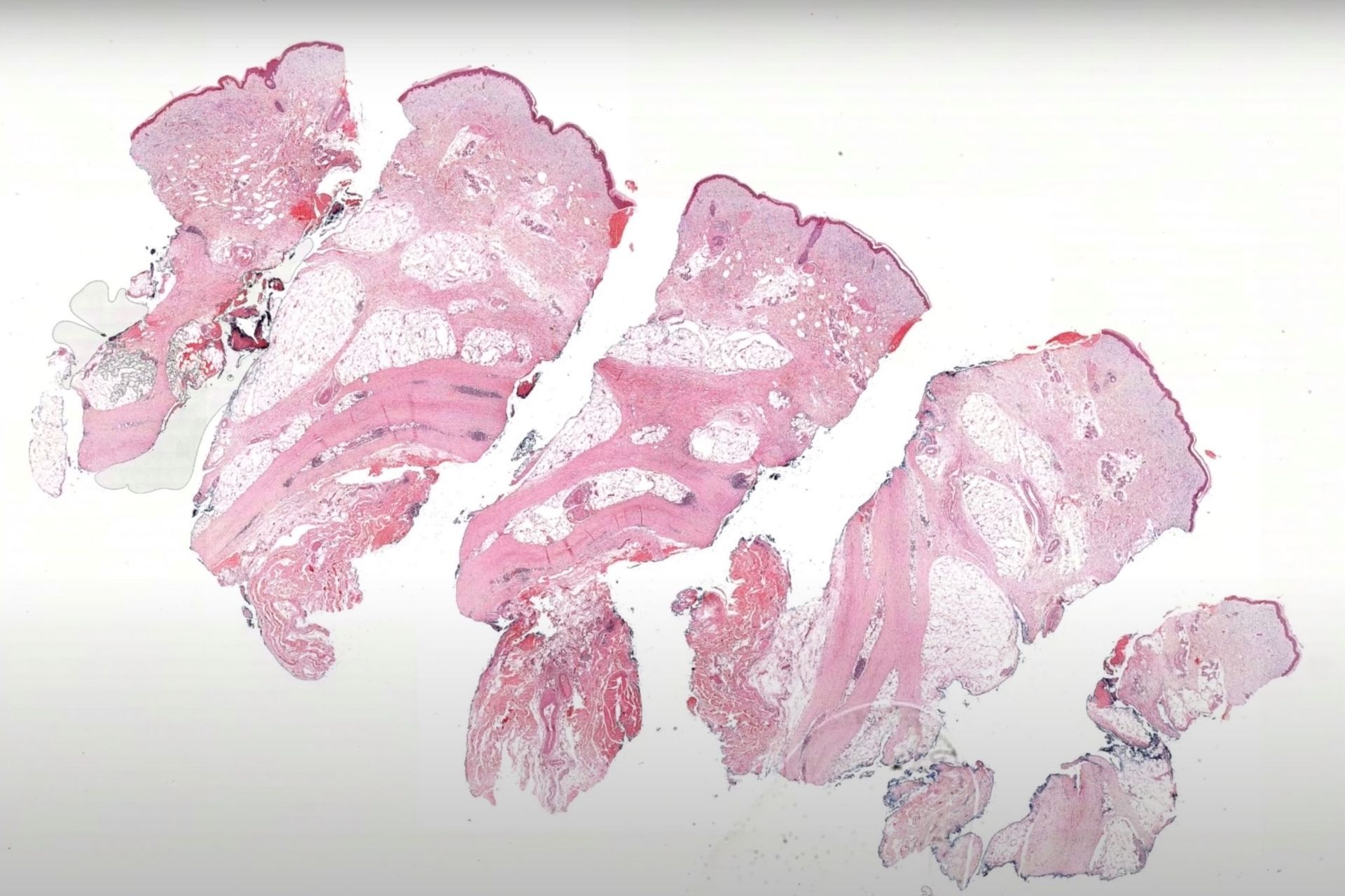 Jerad - Young adult with hard indurated bound-down skin on bilateral ...