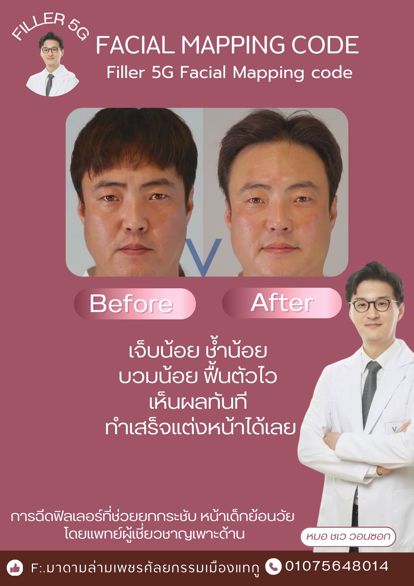 วี - Facial Mapping code Filler 5G Facial Mapping code เจ็บน้อย ช้ำน้อย ...