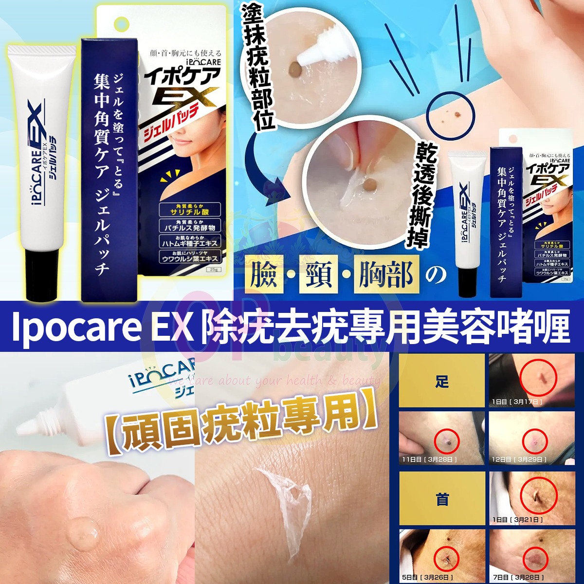OP - 💙Ipocare EX 除疣去疣專用美容啫喱 25g 疣好令人煩惱 | 日本Ipocare幫你擊退頑固疣👊🏻💥 🔹獨特的啫喱質地 ...