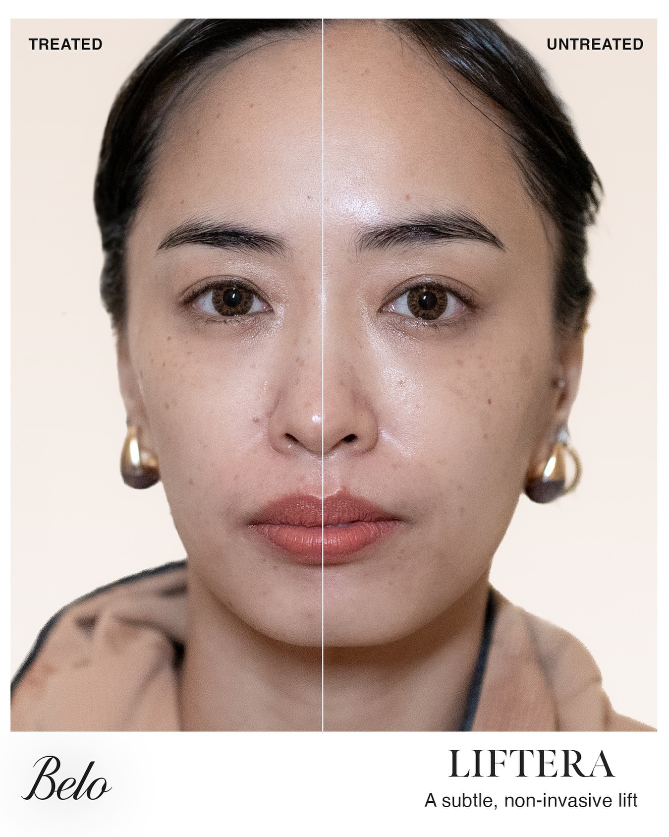 Fresh, lifted skin in just an hour. 😉 Thinking about your first lift? That's the beauty of Belo Liftera A2. It delivers immediate results that refine your contours and keep your skin