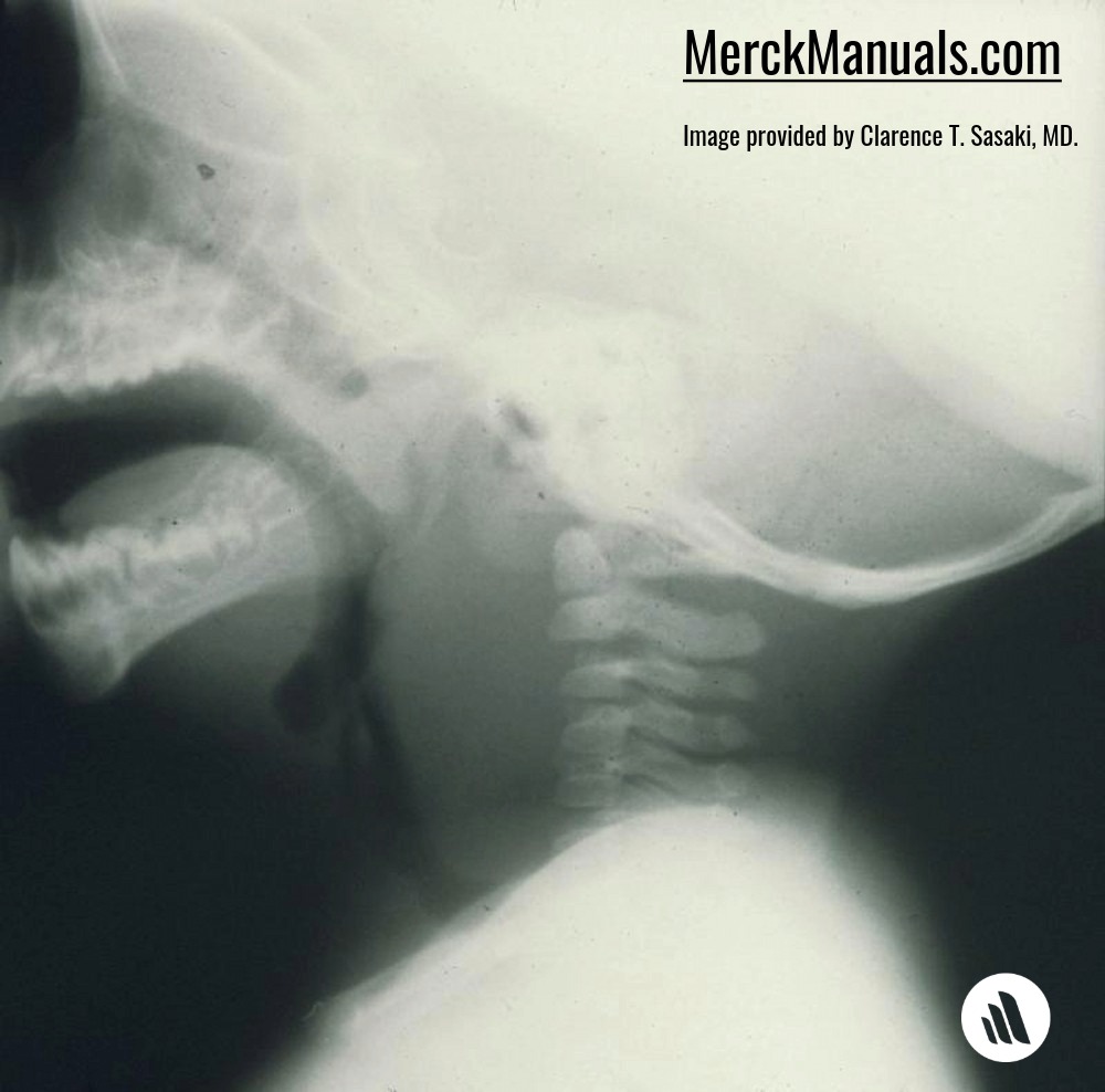 Merck - TEST YOUR KNOWLEDGE: This lateral x-ray of a child shows marked ...
