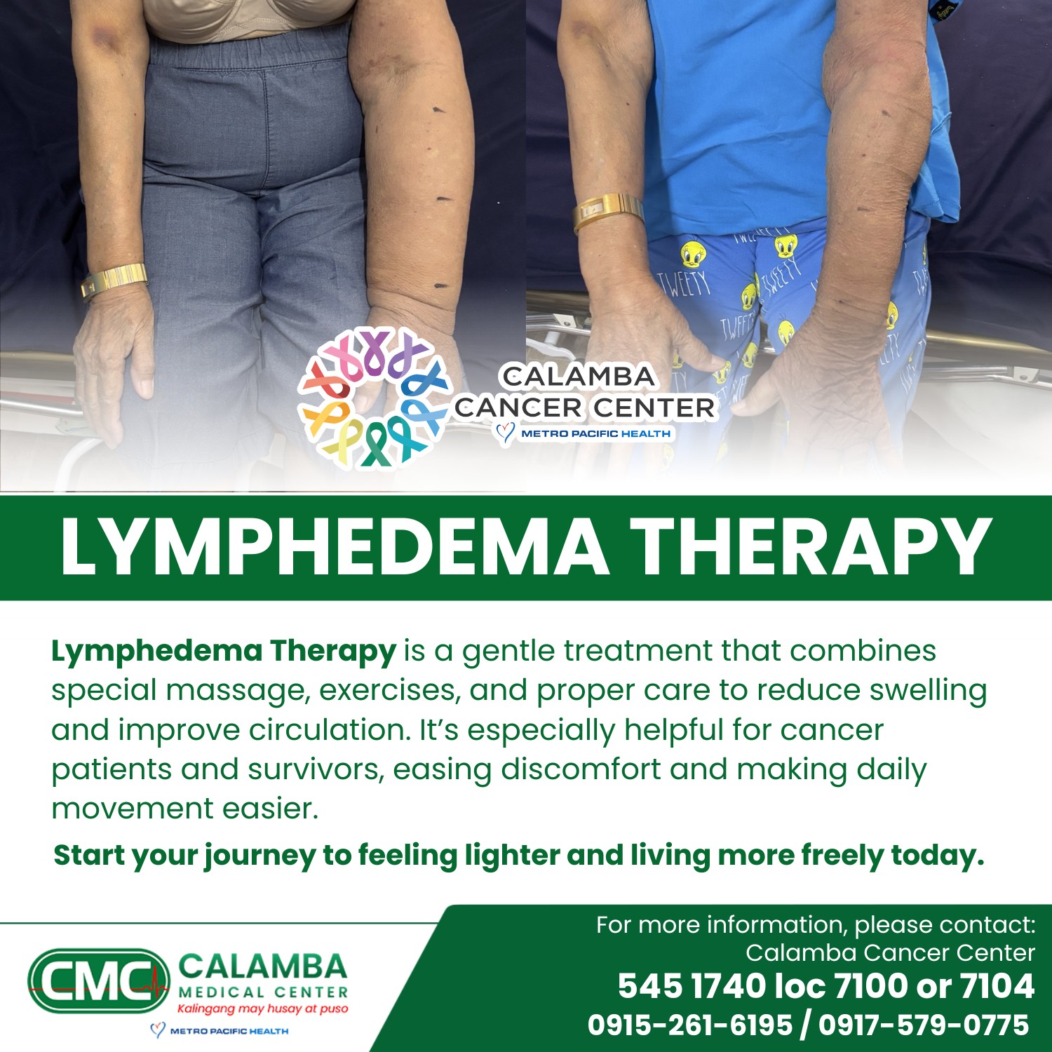 Living with lymphedema can be... - Calamba Medical Center | Facebook