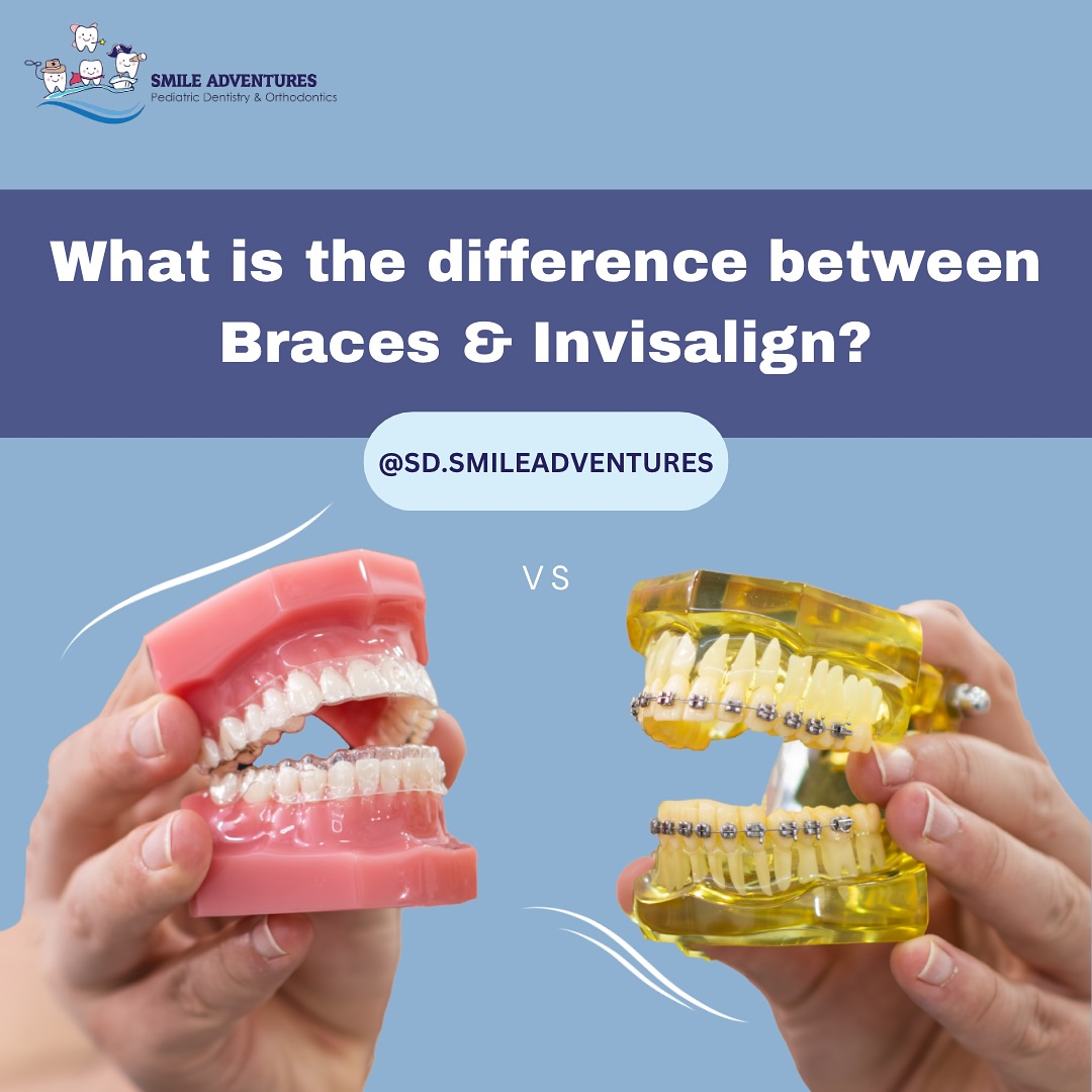 Smile - - 🦷 Braces vs. Invisalign: What’s the Difference? 🤔 Both braces ...