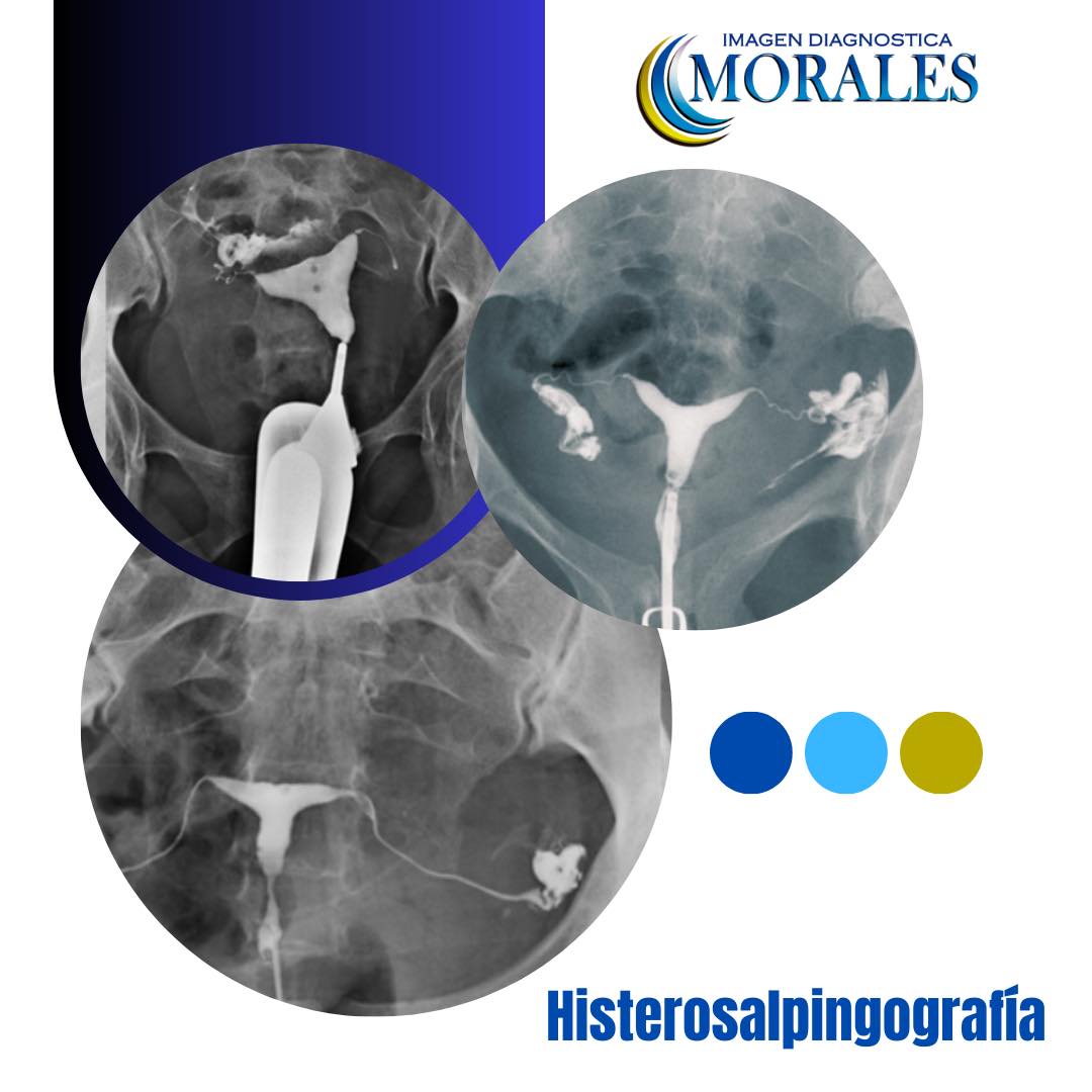 histerosalpingograf-a-la-imagen-diagn-stica-morales