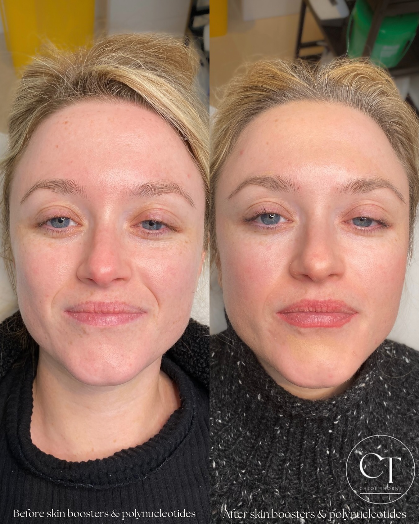 Chloë - The Power of Polynucleotides & Skin Boosters for Radiant, Glass ...