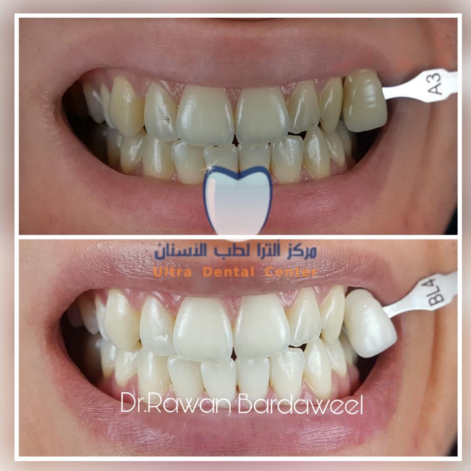 تبييض الاسنان Teeth Whitening Ultra Dental Center Qatar Facebook