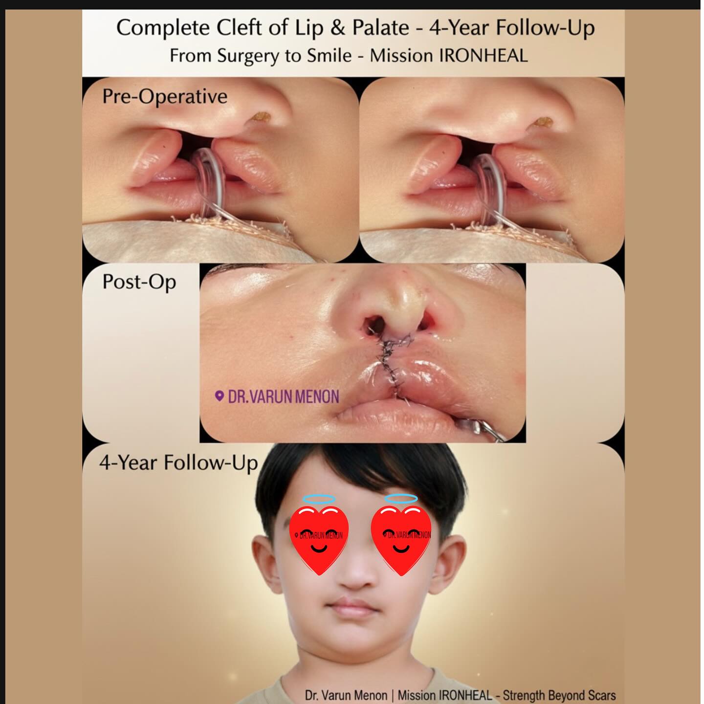 Dr.VARUN MENON - 💙 Complete Cleft of Lip & Palate – 4-Year... | Facebook
