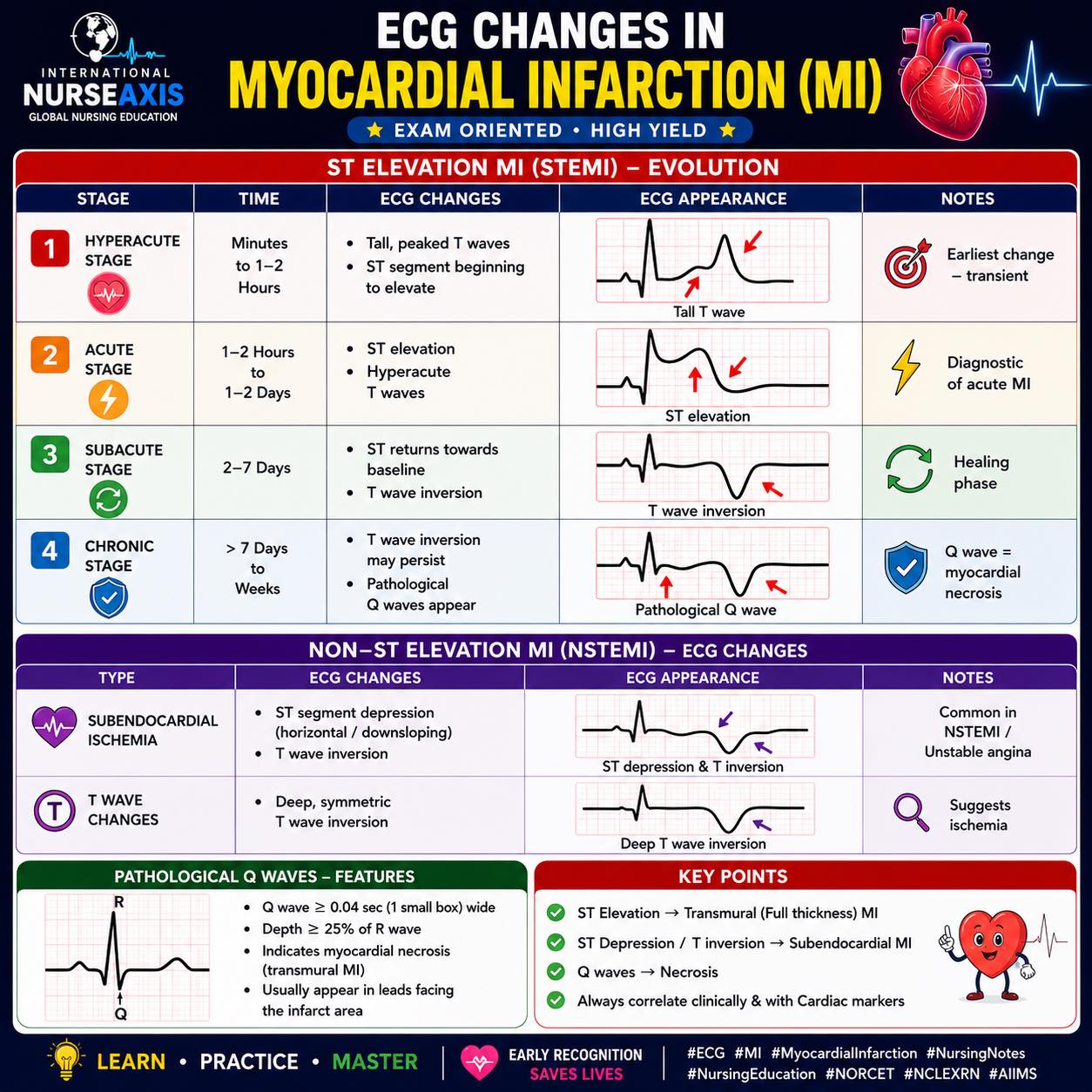 Time is Muscle: Understanding ECG Patterns in Acute MI.🫀 #stemi