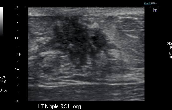 Can you spot mitral valve calcification on this X-ray?” Mitral valve ...