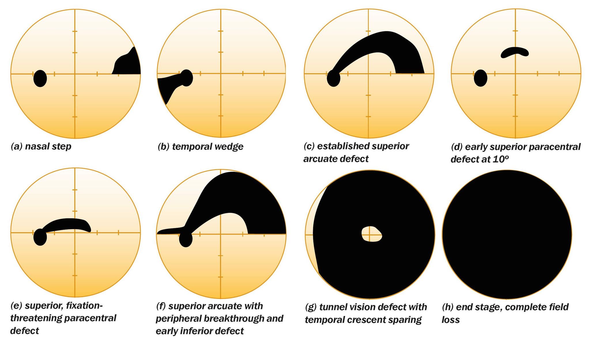 Optometry & Vision Sciences | 👁️ Visual Field Defects in Glaucoma ...