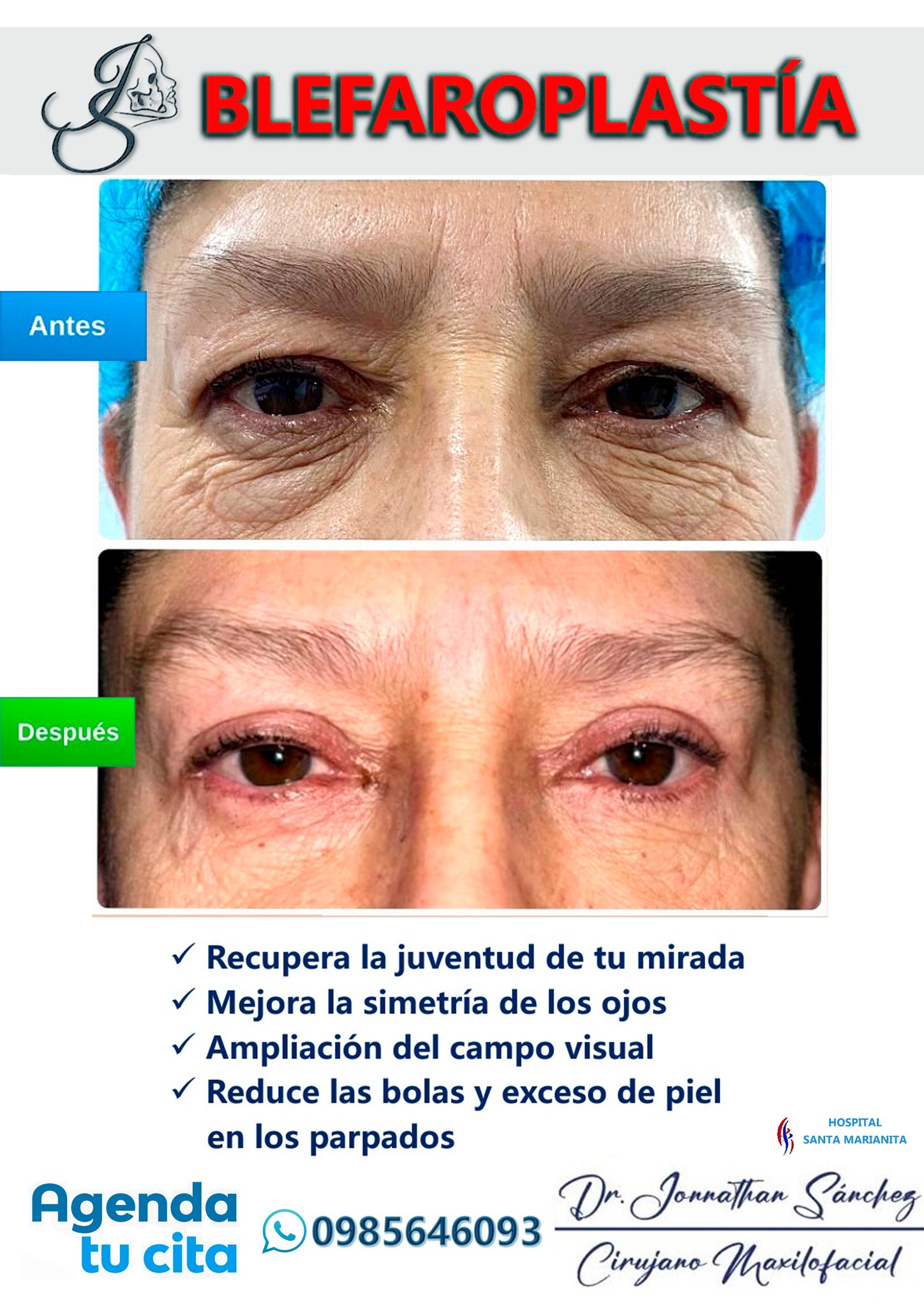 Dr. - ¡Recupera la juventud de tu mirada con BLEFAROPLASTIA ️ Elimina ...