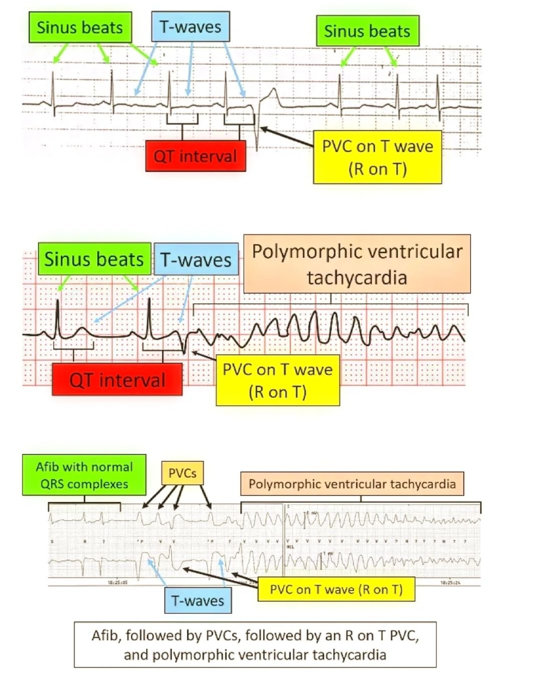 House - #ECG Afib, followed by PVCs, followed by an R on T PVC, and ...
