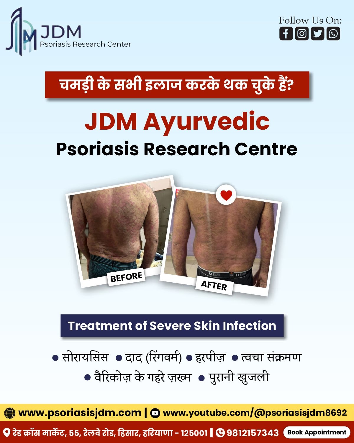 Psoriasis JDM | Hisar