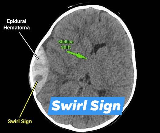Neurosurgery | Hematima expansion sign in brain | Facebook