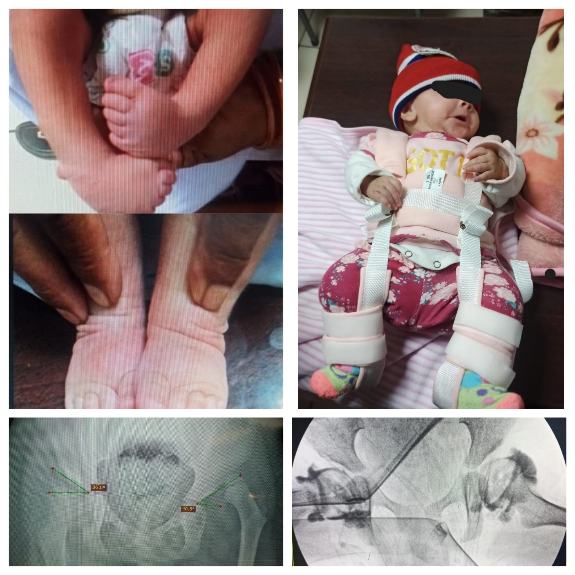 Best method for Circumcision in Children | When and How to do it. ختنہ ...